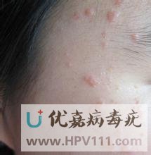 治扁平疣的偏方