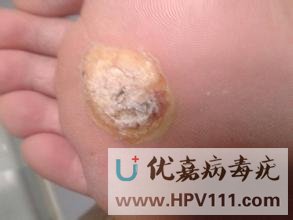 脚上长跖疣是怎么回事