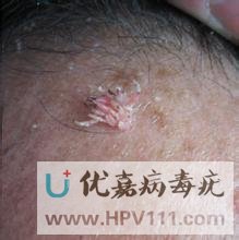 丝状疣看什么科