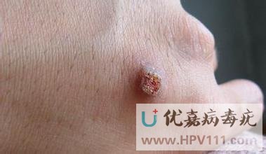寻常疣激光治疗有效吗