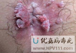 如何及早的发现尖锐湿疣
