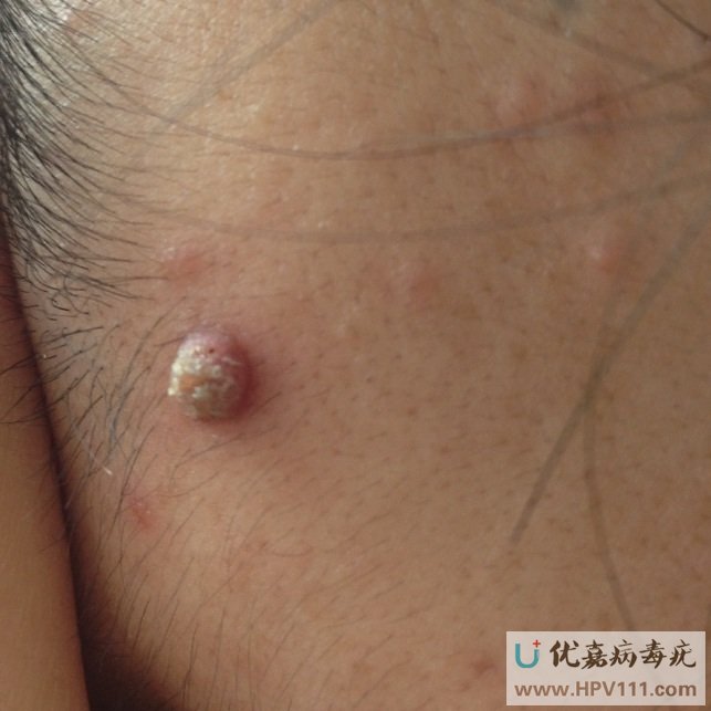 正文 扁平疣症状:皮损为绿豆至豌豆大小,或者是更大的扁平丘疹