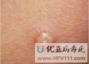 传染性软疣的潜伏期有什么表现