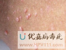 HPV